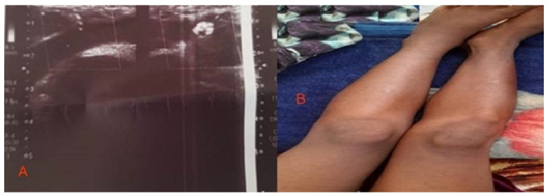 Deep Vein Thrombosis of the Left Lower Limb in a Sudanese Child with Sickle Cell Disease.