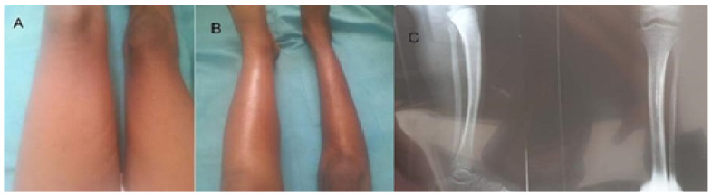 Deep Vein Thrombosis of the Left Lower Limb in a Sudanese Child with Sickle Cell Disease.