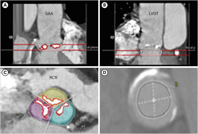 Distribution of Aortic Root Calcium in Relation to Frame Expansion and Paravalvular Leakage After Transcatheter Aortic Valve Implantation (TAVI): An Observational Study Using a Patient-specific Contrast Attenuation Coefficient for Calcium Definition and Independent Core Lab Analysis of Paravalvular Leakage.