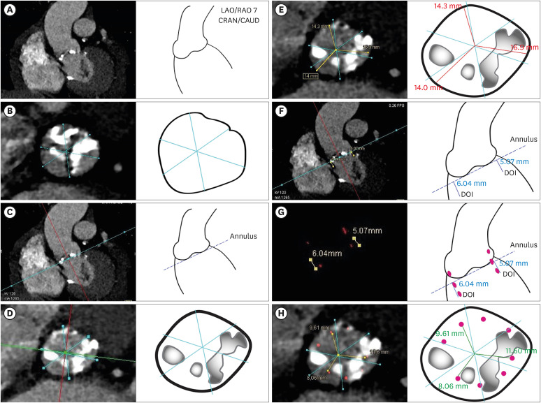 Distribution of Aortic Root Calcium in Relation to Frame Expansion and Paravalvular Leakage After Transcatheter Aortic Valve Implantation (TAVI): An Observational Study Using a Patient-specific Contrast Attenuation Coefficient for Calcium Definition and Independent Core Lab Analysis of Paravalvular Leakage.