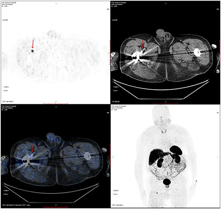 Phosphaturic mesenchymal tumor in right thigh: 2 cases report and literature review.