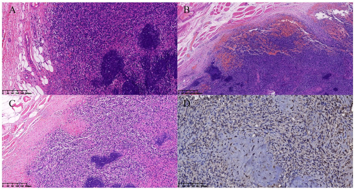 Phosphaturic mesenchymal tumor in right thigh: 2 cases report and literature review.