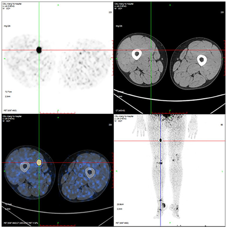 Phosphaturic mesenchymal tumor in right thigh: 2 cases report and literature review.