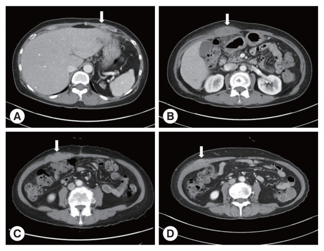 Phylogenetic Characteristics of Fasciola hepatica Isolated from a Korean Patient.