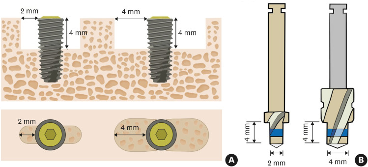 The healing pattern of a 4 mm proximal infrabony defect was not significantly different from a 2 mm defect adjacent to dental implant in a canine mandible.