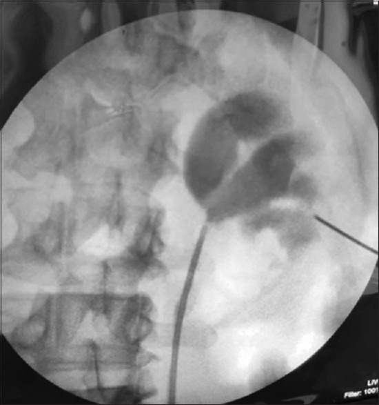 A comparative study of air pyelogram and contrast pyelogram for initial puncture access and to see its efficacy during percutaneous nephrolithotomy.