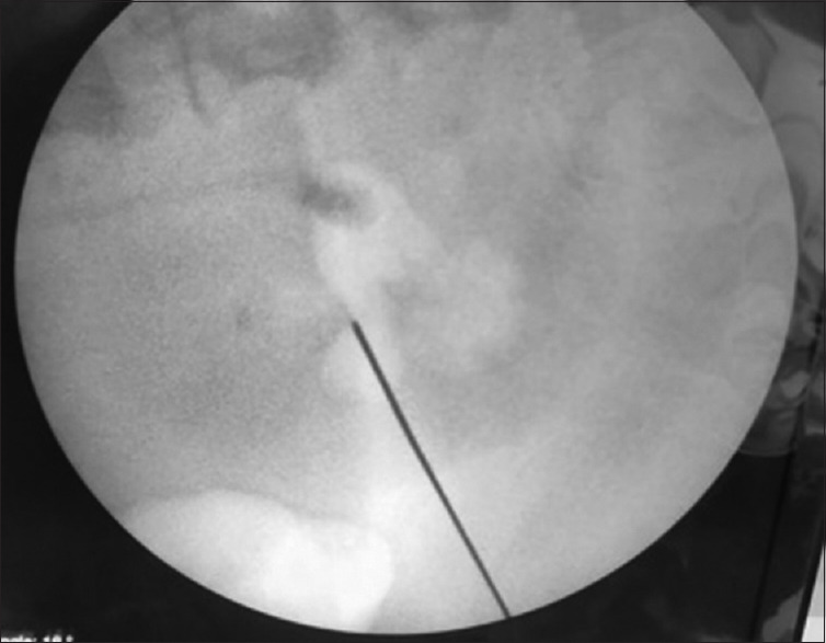 A comparative study of air pyelogram and contrast pyelogram for initial puncture access and to see its efficacy during percutaneous nephrolithotomy.