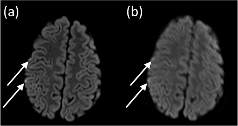 Quiet Diffusion-weighted MR Imaging of the Brain for Pediatric Patients with Moyamoya Disease.