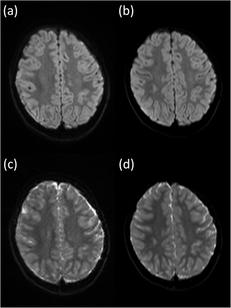 Quiet Diffusion-weighted MR Imaging of the Brain for Pediatric Patients with Moyamoya Disease.