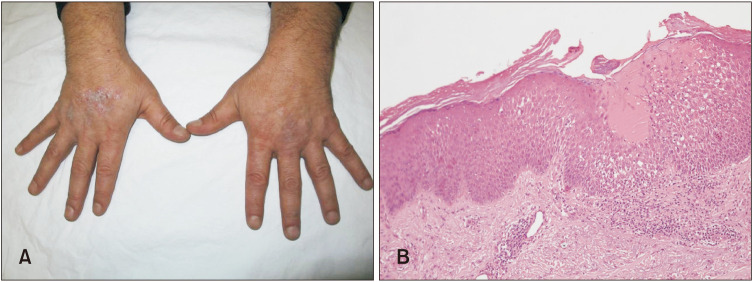 Familial Actinic Lichen Planus: Three Cases from the Same Family.