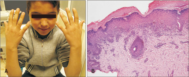 Familial Actinic Lichen Planus: Three Cases from the Same Family.