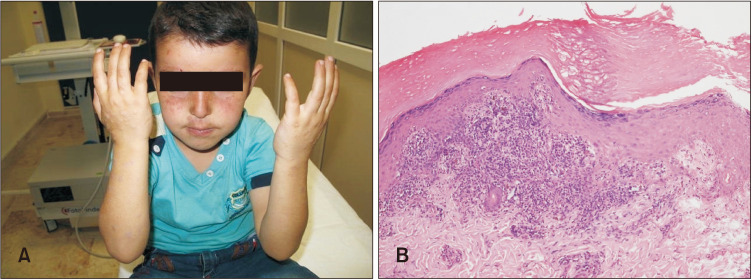 Familial Actinic Lichen Planus: Three Cases from the Same Family.