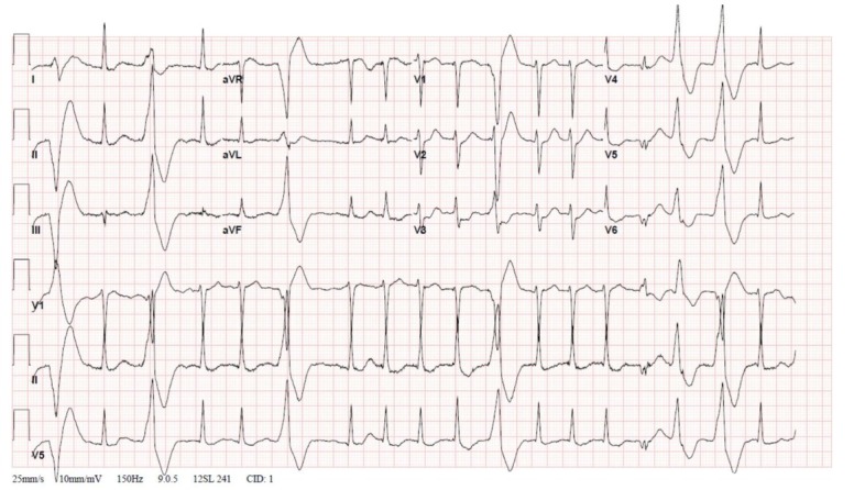 Treatment of Lethal Caffeine Overdose with Haemodialysis: A Case Report and Review.