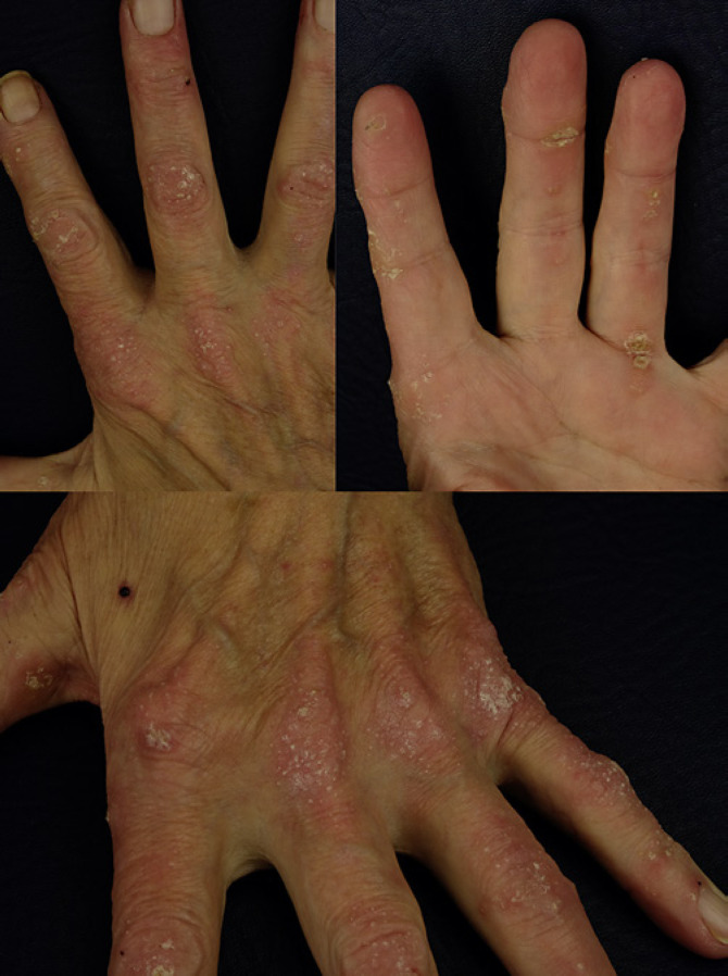 Acrokeratosis Paraneoplastica (Bazex Syndrome): A Case Report.