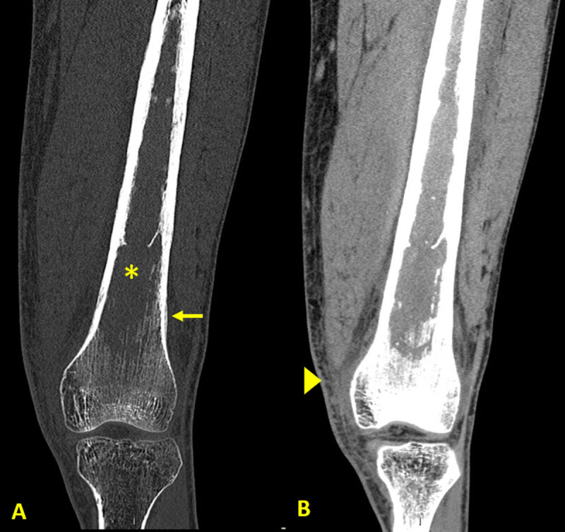 Lymphoma Presenting as a Soft Tissue Mass.