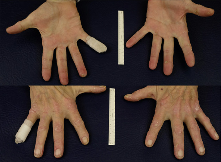 Acrokeratosis Paraneoplastica (Bazex Syndrome): A Case Report.