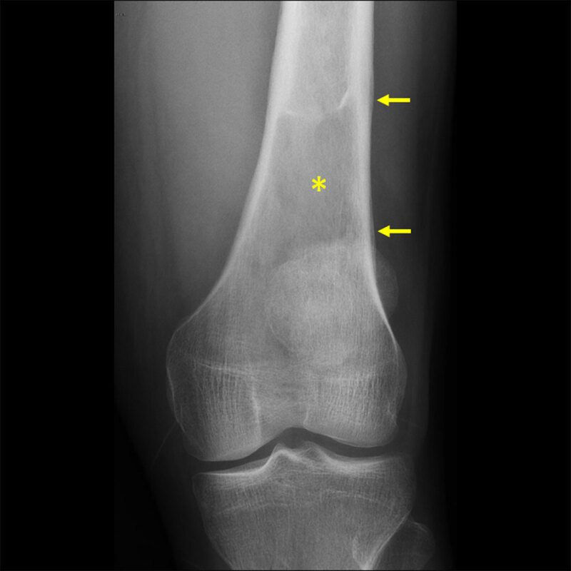 Lymphoma Presenting as a Soft Tissue Mass.