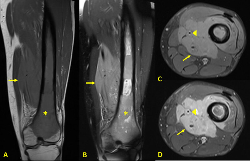 Lymphoma Presenting as a Soft Tissue Mass.