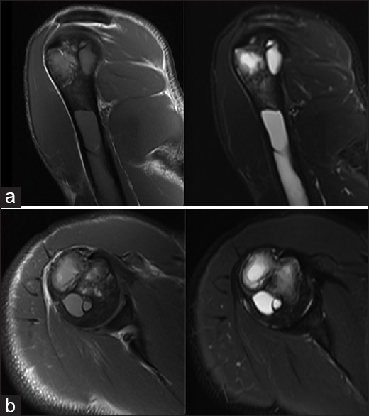 Unusual magnetic resonance imaging findings of cystic bone lesions in congenital generalized lipodystrophy.