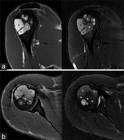 Unusual magnetic resonance imaging findings of cystic bone lesions in congenital generalized lipodystrophy.