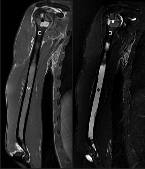 Unusual magnetic resonance imaging findings of cystic bone lesions in congenital generalized lipodystrophy.