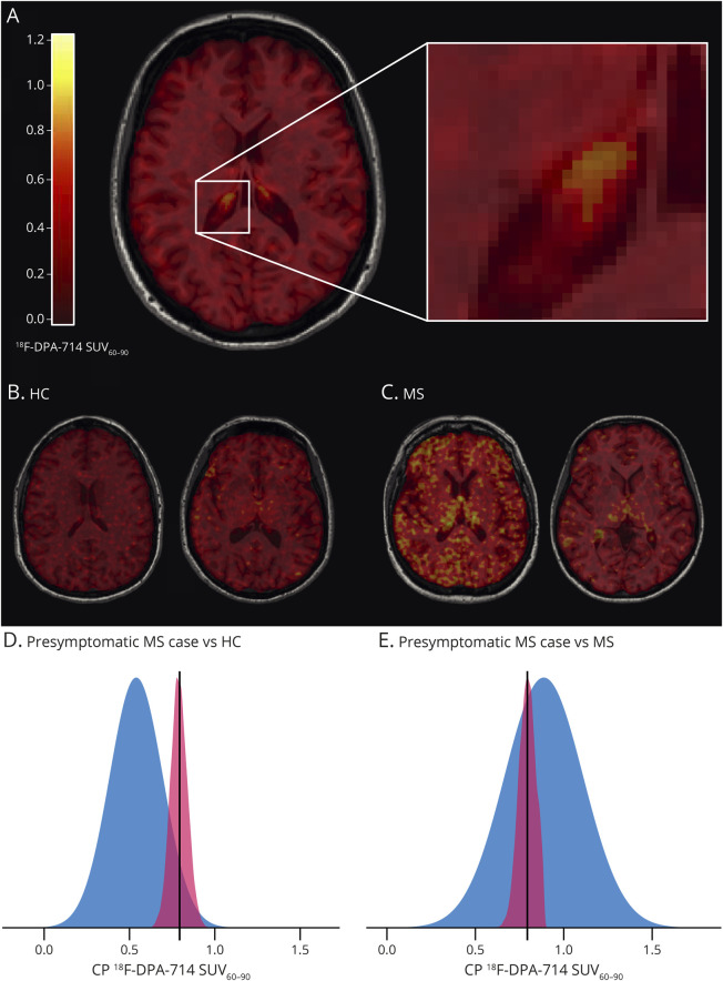 Imaging Characteristics of Choroid Plexuses in Presymptomatic Multiple Sclerosis: A Retrospective Study.