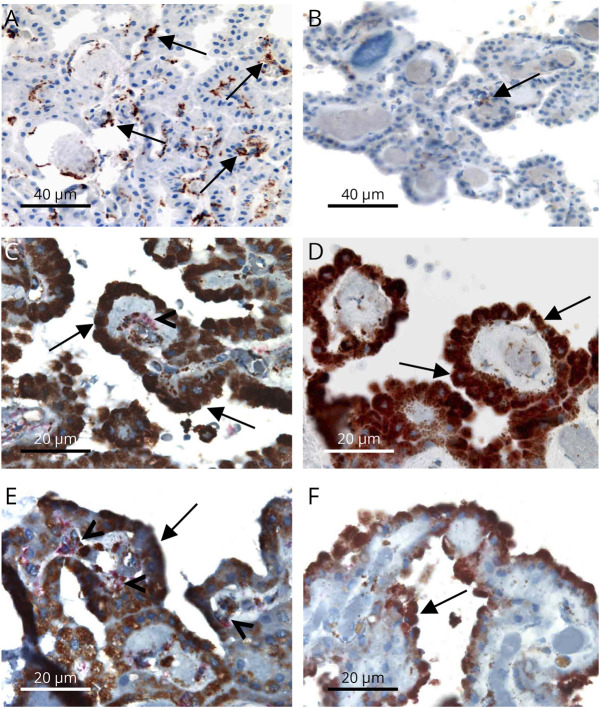 Imaging Characteristics of Choroid Plexuses in Presymptomatic Multiple Sclerosis: A Retrospective Study.