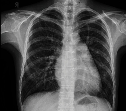 The First Successful Transcatheter Closure of an Inferior Sinus Venosus Defect with Anomalous Drainage of the Right Lower Pulmonary Vein Using Bare and Covered Stents: A Single-Case Report.
