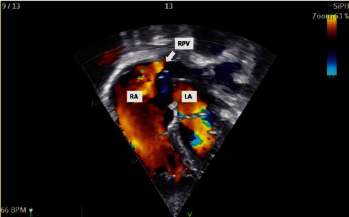 The First Successful Transcatheter Closure of an Inferior Sinus Venosus Defect with Anomalous Drainage of the Right Lower Pulmonary Vein Using Bare and Covered Stents: A Single-Case Report.