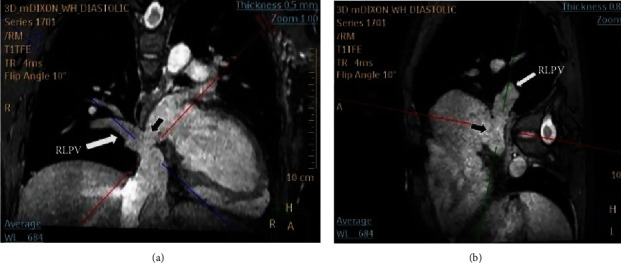 The First Successful Transcatheter Closure of an Inferior Sinus Venosus Defect with Anomalous Drainage of the Right Lower Pulmonary Vein Using Bare and Covered Stents: A Single-Case Report.