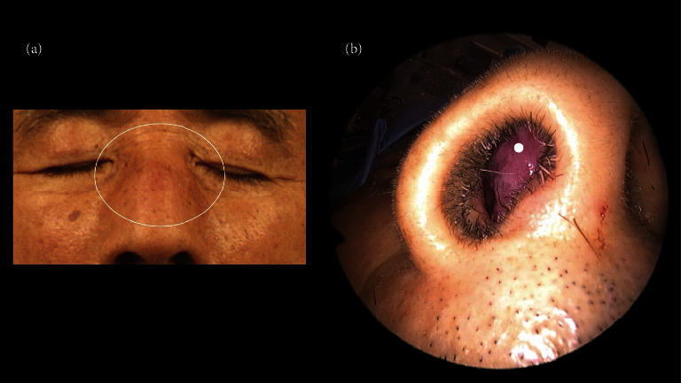 A Case of Granulomatosis with Polyangiitis (GPA) Where a Multicystic Nasal Septal Abscess Aided in the Diagnosis.