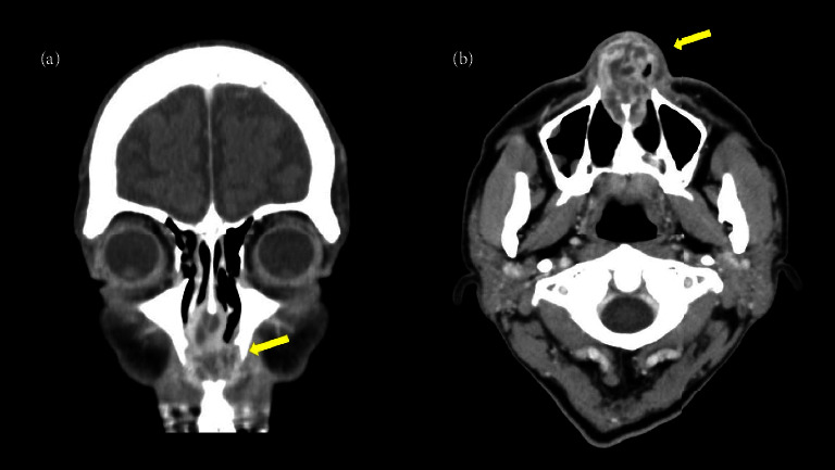 A Case of Granulomatosis with Polyangiitis (GPA) Where a Multicystic Nasal Septal Abscess Aided in the Diagnosis.