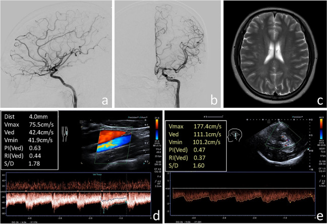 Ultrasound parameters associated with stroke in patients with moyamoya disease: a logistic regression analysis.