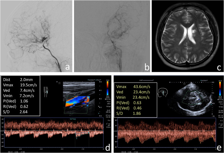 Ultrasound parameters associated with stroke in patients with moyamoya disease: a logistic regression analysis.