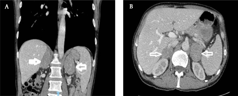 Adrenal Lymphoma: Case Reports and Mini-review.