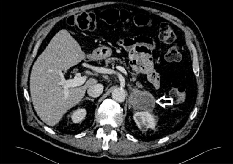 Adrenal Lymphoma: Case Reports and Mini-review.