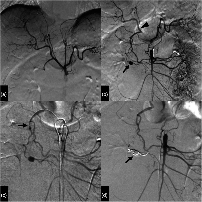 Transcatheter arterial embolization for bleeding from the pancreaticoduodenal artery in patients with celiac artery stenosis: A technical report.