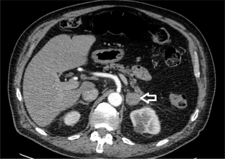 Adrenal Lymphoma: Case Reports and Mini-review.