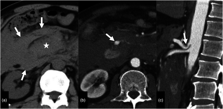 Transcatheter arterial embolization for bleeding from the pancreaticoduodenal artery in patients with celiac artery stenosis: A technical report.