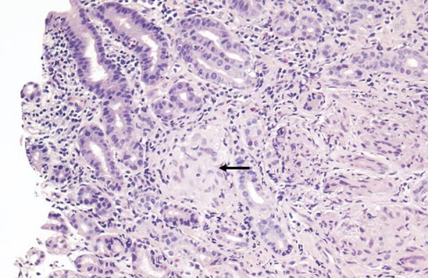 Symptomatic Gastric Sarcoidosis in a Patient with Pulmonary and Neurosarcoidosis: A Case Report.