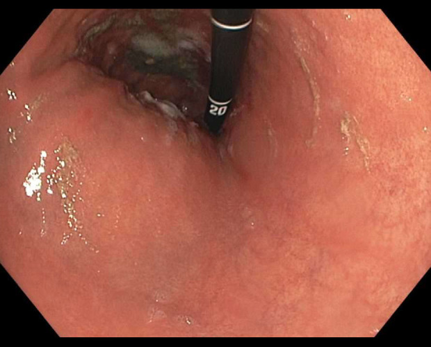 Symptomatic Gastric Sarcoidosis in a Patient with Pulmonary and Neurosarcoidosis: A Case Report.