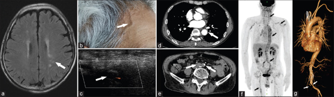 Giant cell arteritis with stroke and systemic diffuse vasculitis.