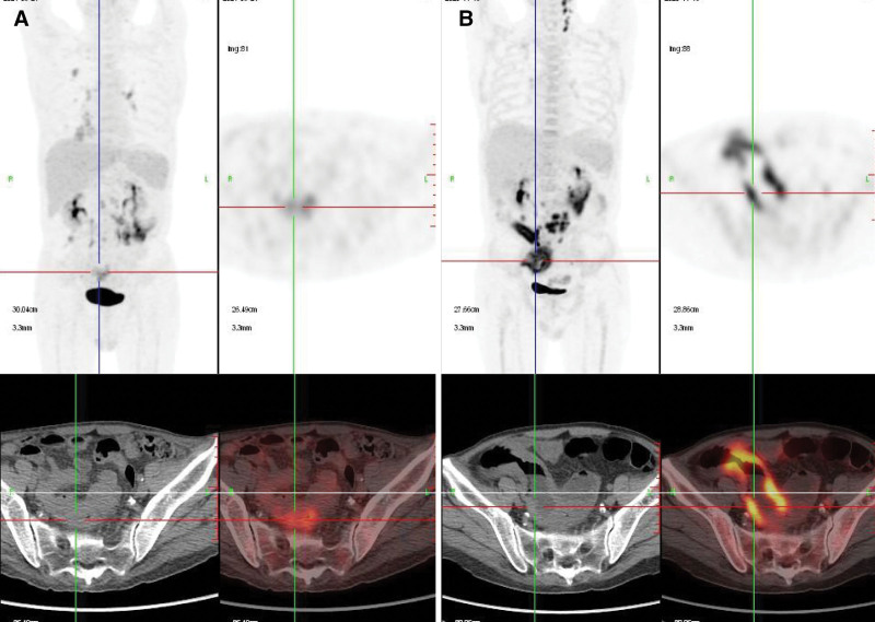 Pulmonary tuberculosis infection and CMV reactivation following daratumumab treatment in a patient with relapsed plasmablastic lymphoma.