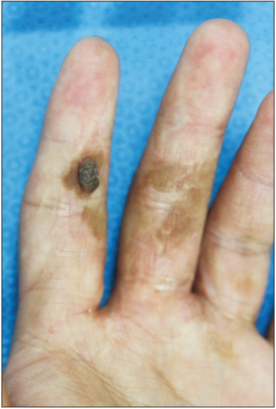 A Case of Seborrheic Keratosis on the Volar Side of the Fingers after Skin Graft.