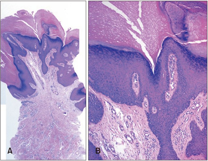 A Case of Seborrheic Keratosis on the Volar Side of the Fingers after Skin Graft.