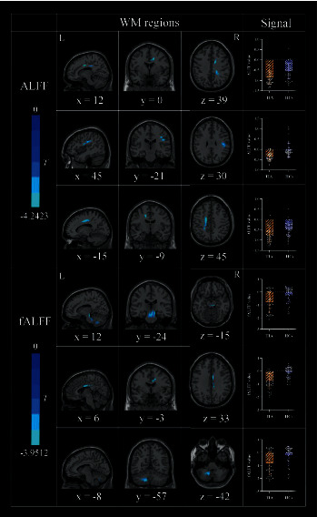 The White Matter Functional Abnormalities in Patients with Transient Ischemic Attack: A Reinforcement Learning Approach.