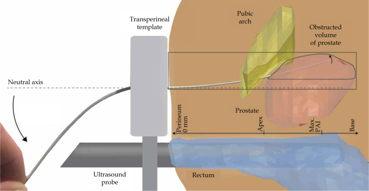 Overcoming pubic arch interference in prostate brachytherapy using steerable needles.