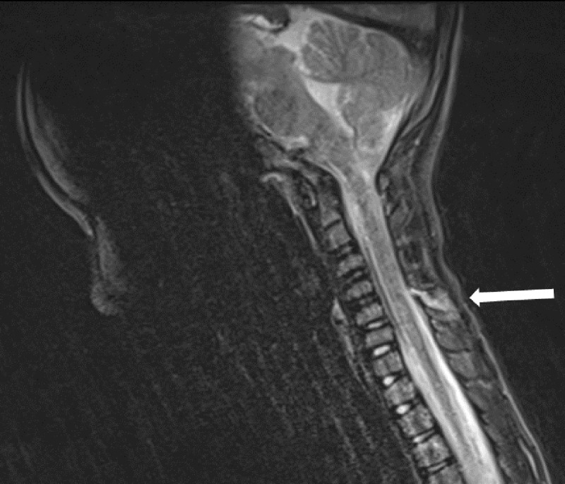 Cervical Interspinous Ligament Sprain in a 6-Year-Old Boy.