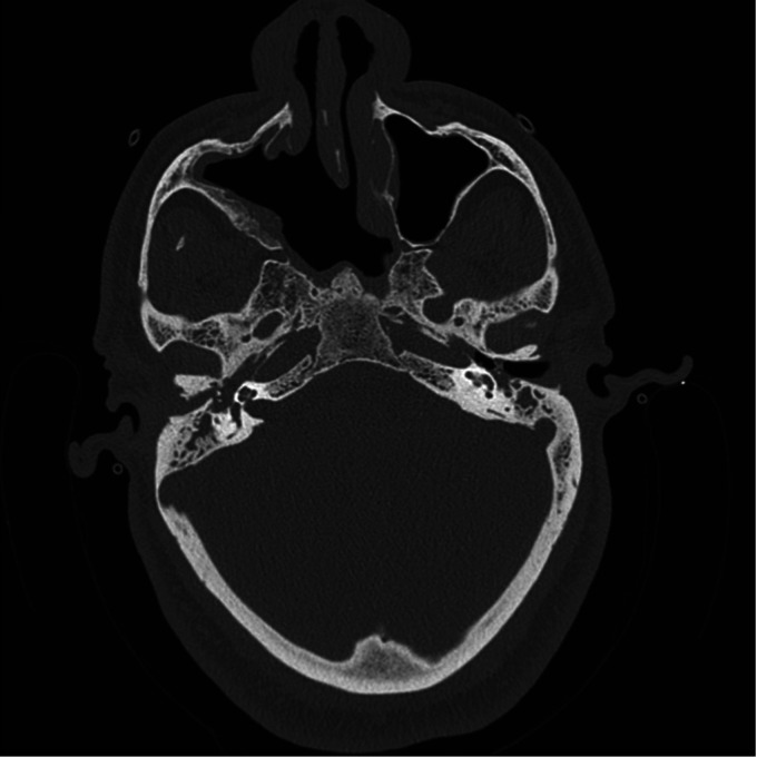 Inverted Papilloma of the Middle Ear: Two New Cases and Systematic Review.