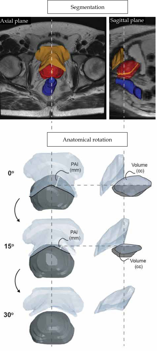 Overcoming pubic arch interference in prostate brachytherapy using steerable needles.